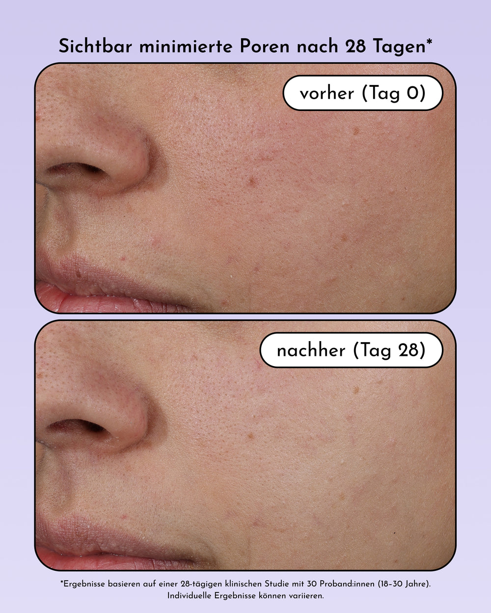 Nahaufnahme einer Wange: oberes Bild „vorher (Tag 0)“ mit sichtbaren Poren und unreiner Haut, unteres Bild „nachher (Tag 28)“ mit glatterer Haut und weniger Poren. Verwendetes Produkt: INAO by essence Fine Time Pore Minimizer Serum.